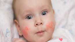 嬰兒溼疹究竟有多大危害?