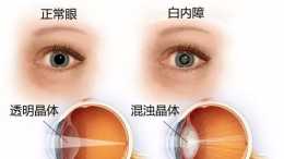 這個幾乎人人都會得的眼疾病，早期有哪些症狀？