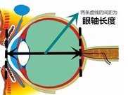 科普 | 眼軸長度評估在近視防控中的重要作用！